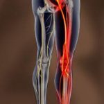 Sciatalgia e Osteopatia